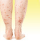 Take the Quiz: Skin Diseases